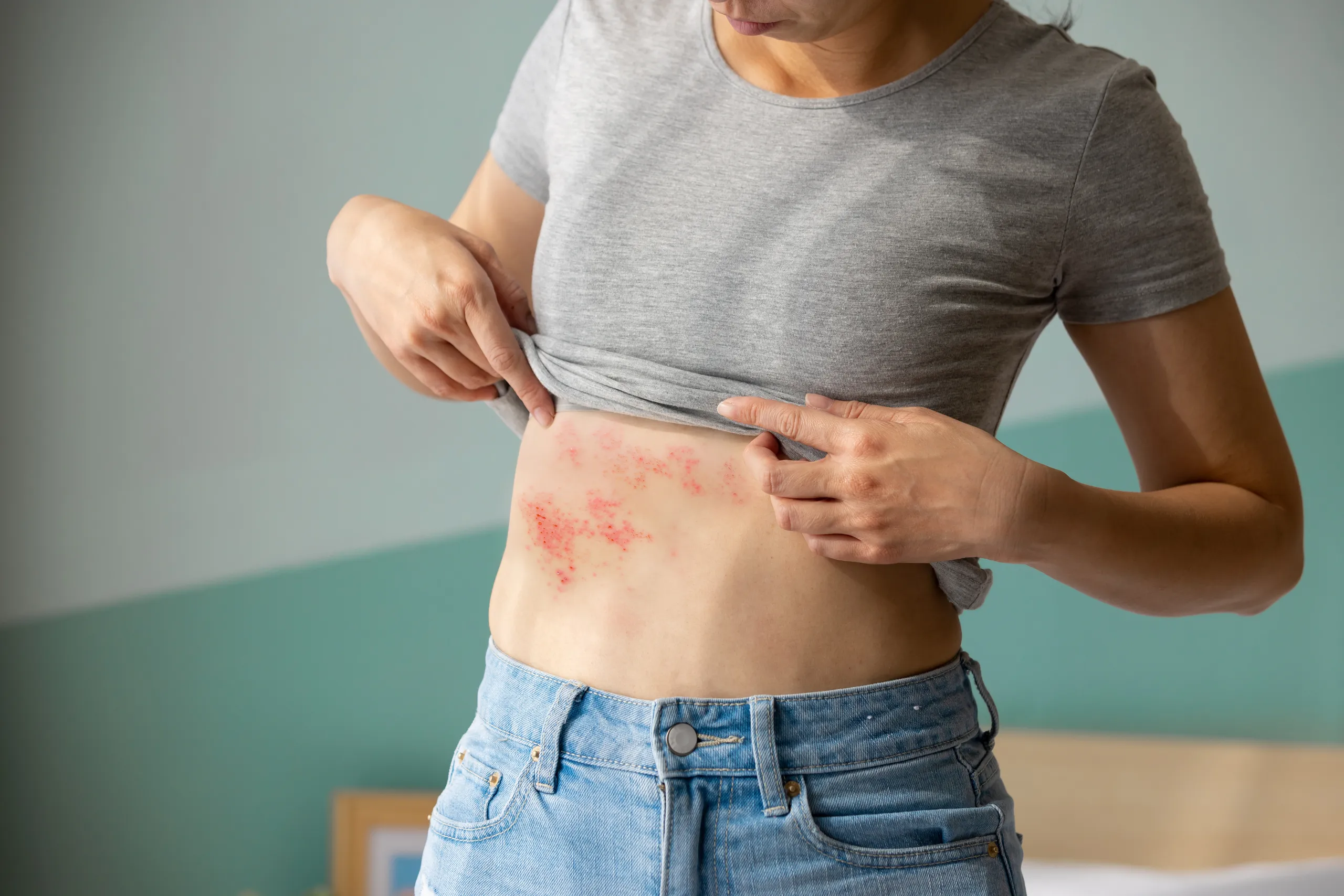 Paciente con herpes zóster