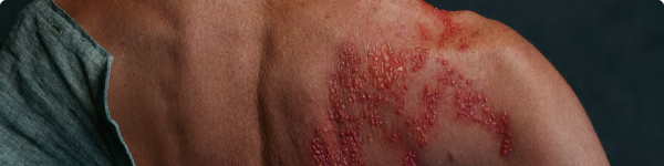 Dolor nervioso a largo plazo